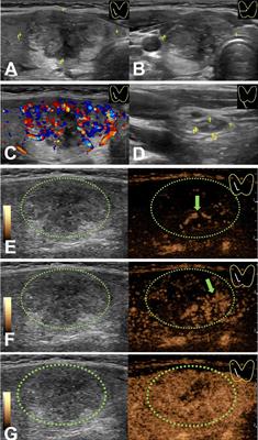 Multimodal predictive factors of metastasis in lymph nodes posterior to the right recurrent laryngeal nerve in papillary thyroid carcinoma